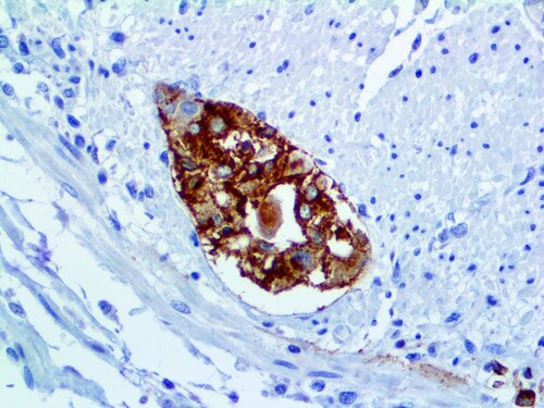 IHC of Varicella Zoster Virus on an FFPE Infected Tissue